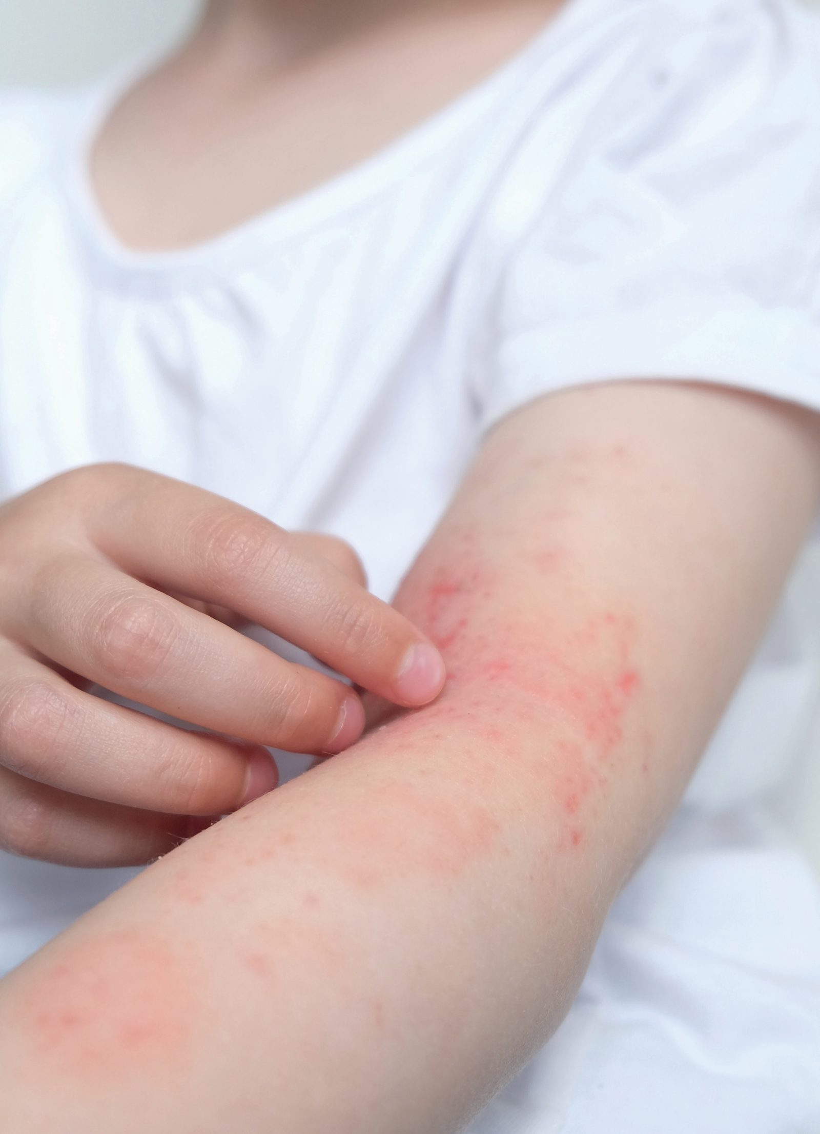 Criança coçando o braço com lesões avermelhadas de dermatite